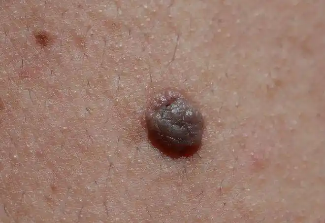 身上若有3处地方"长痘痘",女性不要忽视,hpv已经悄悄上身|宫颈|疣体