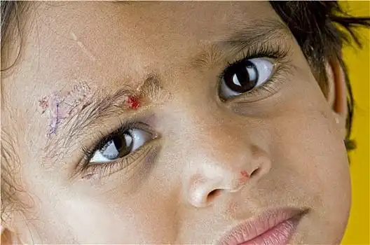 眼睛受伤图片