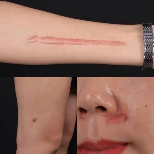 疤痕增生是疤痕疾病的常见形态 ,一般多发于深度烧伤的创面愈合后