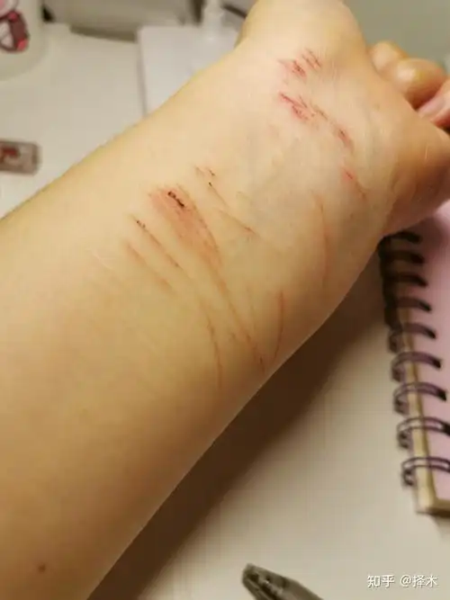 一瓶洋酒 一瓶白酒把自己惯醉了,整崩溃了,随手拿了把眉刀在手腕上割