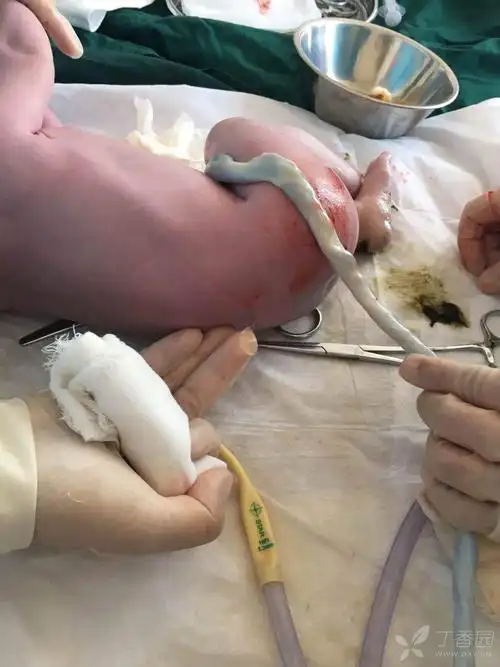 闭合性脊柱裂有产后图片 [病例帖]