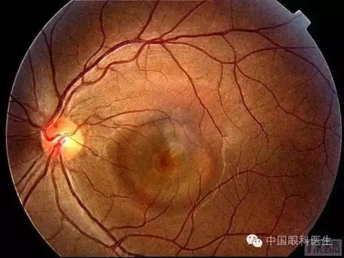 高清晰典型眼底病图片(工作,学习都很珍贵的病例图片)