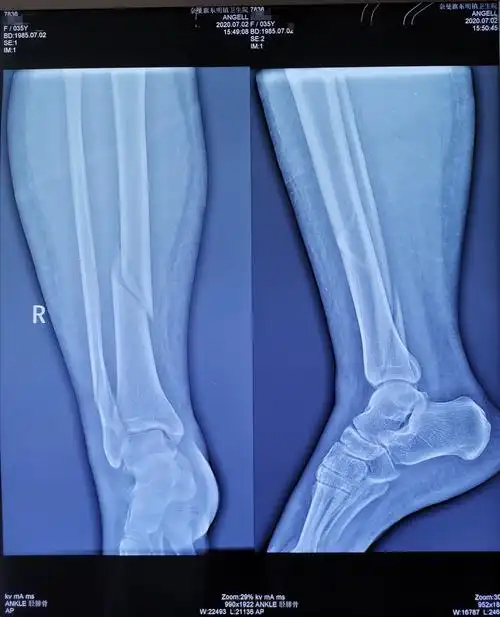 通辽市第二人民医院骨科为35岁女性右胫腓骨下段骨折患者行胫骨闭合