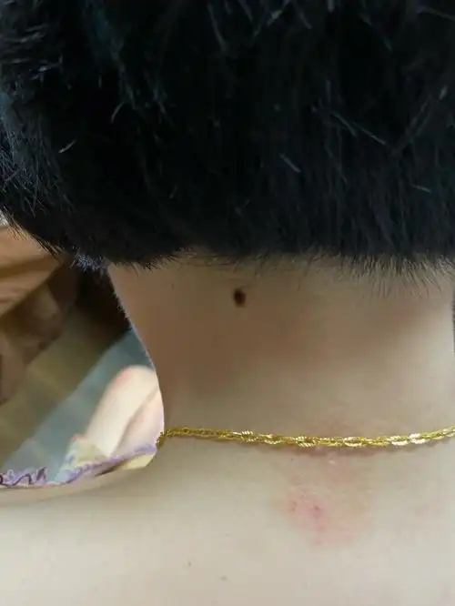 突出的血管痣祛除后效果图来喽