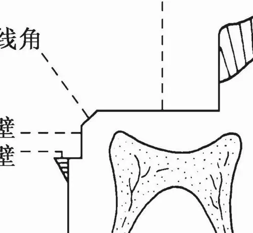 梯形结构(trapezoidal structure)的组成包括龈壁,轴壁,髓壁,近/远中