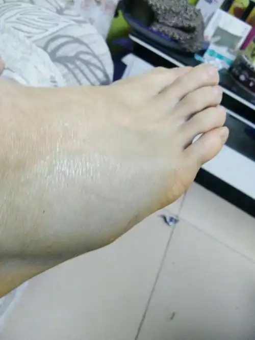 崴脚了――第一次脚肿这么厉害!