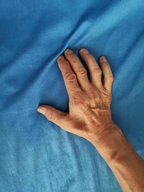 手部麻木肌肉萎缩-肘管综合征