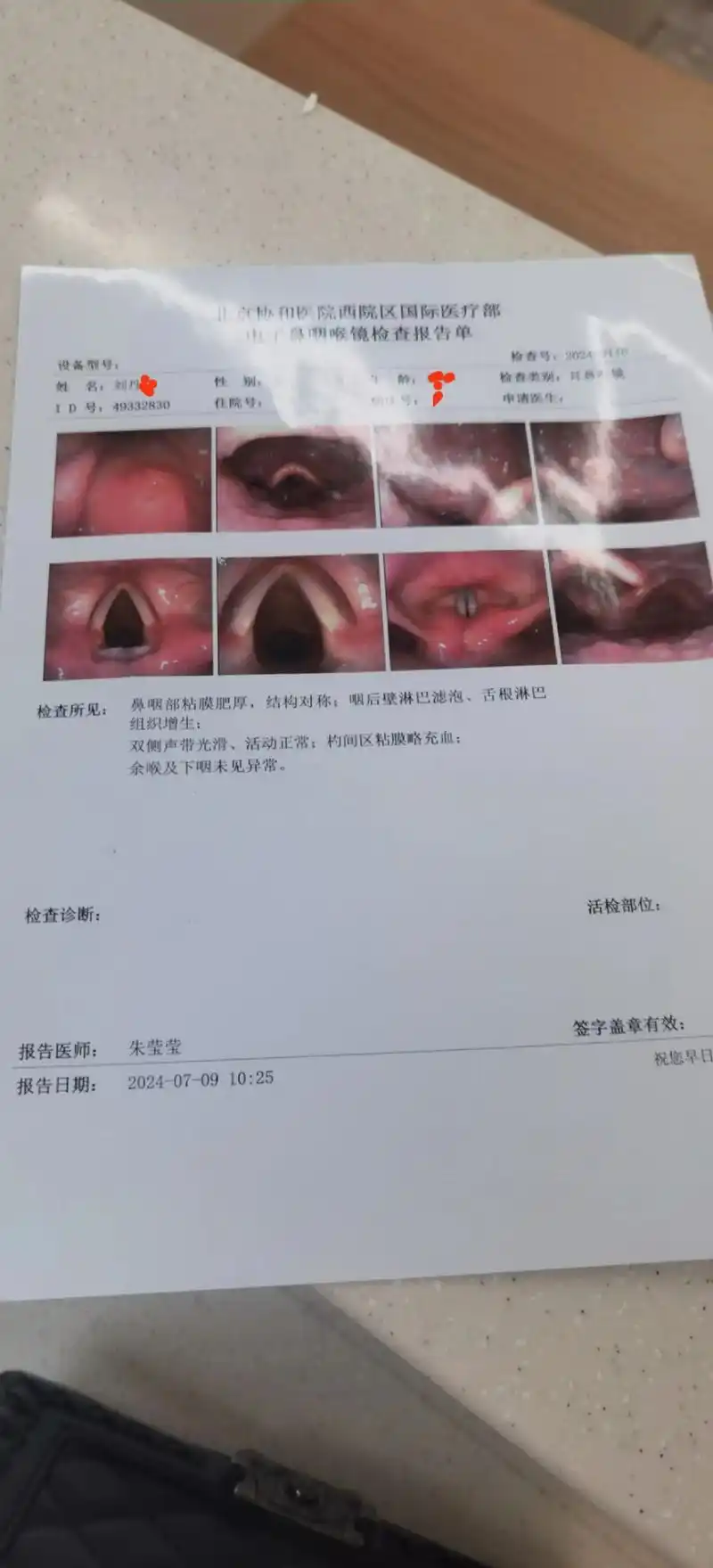 声带也没有怎样,没有小结也没有息肉,就是慢性咽炎长期用嗓过度引起的
