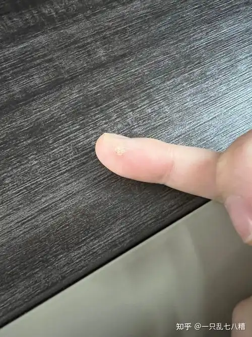 白醋去疣实操4天去除真的可